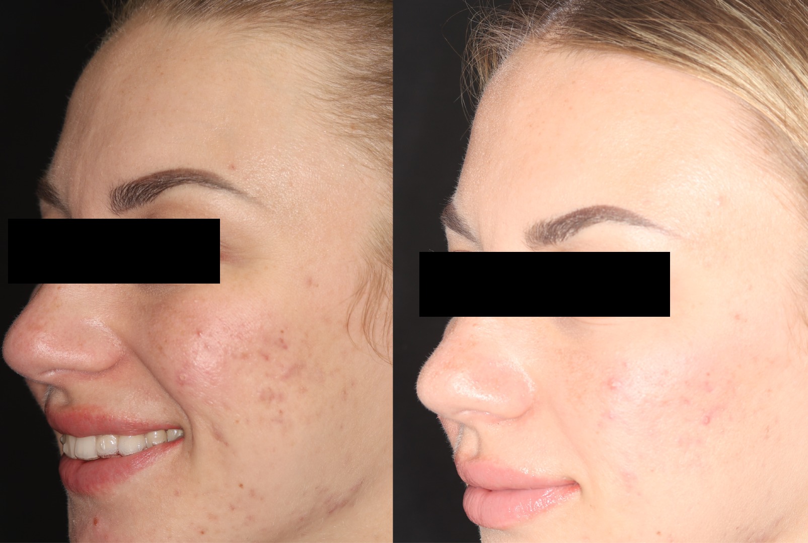 Botox