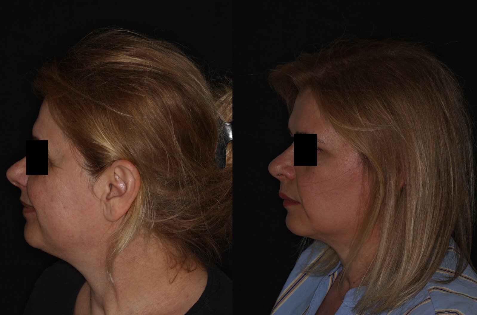 Botox
