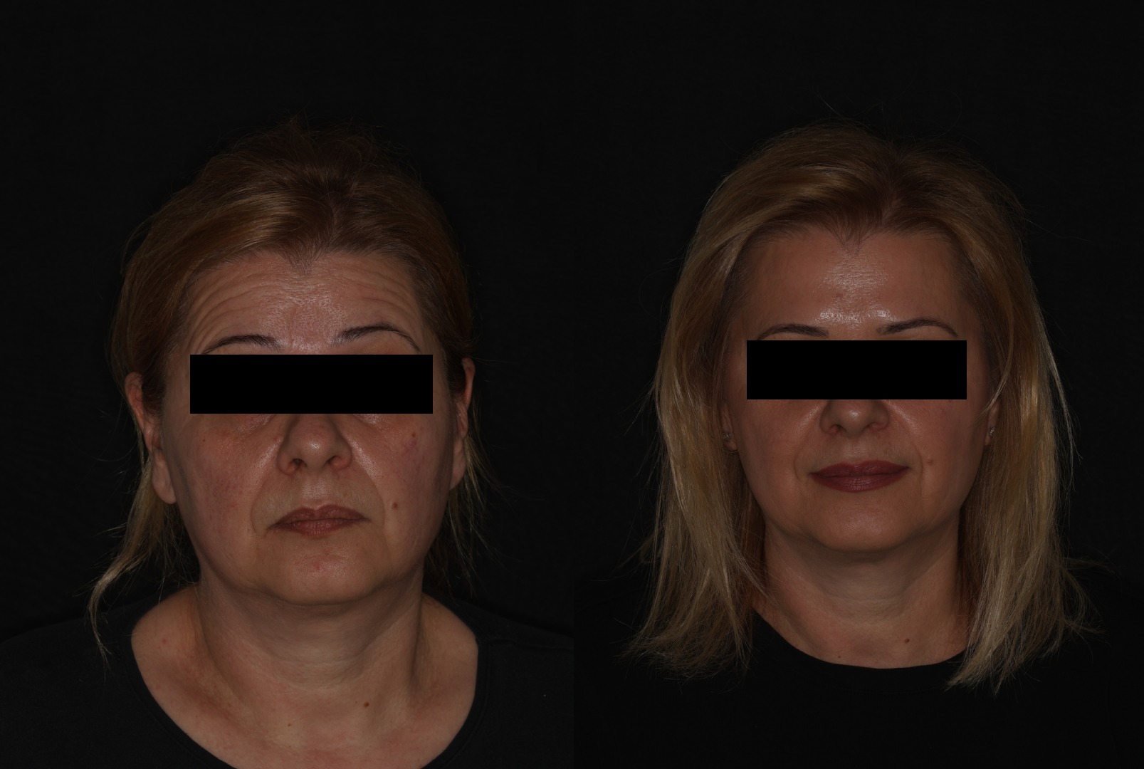 Botox