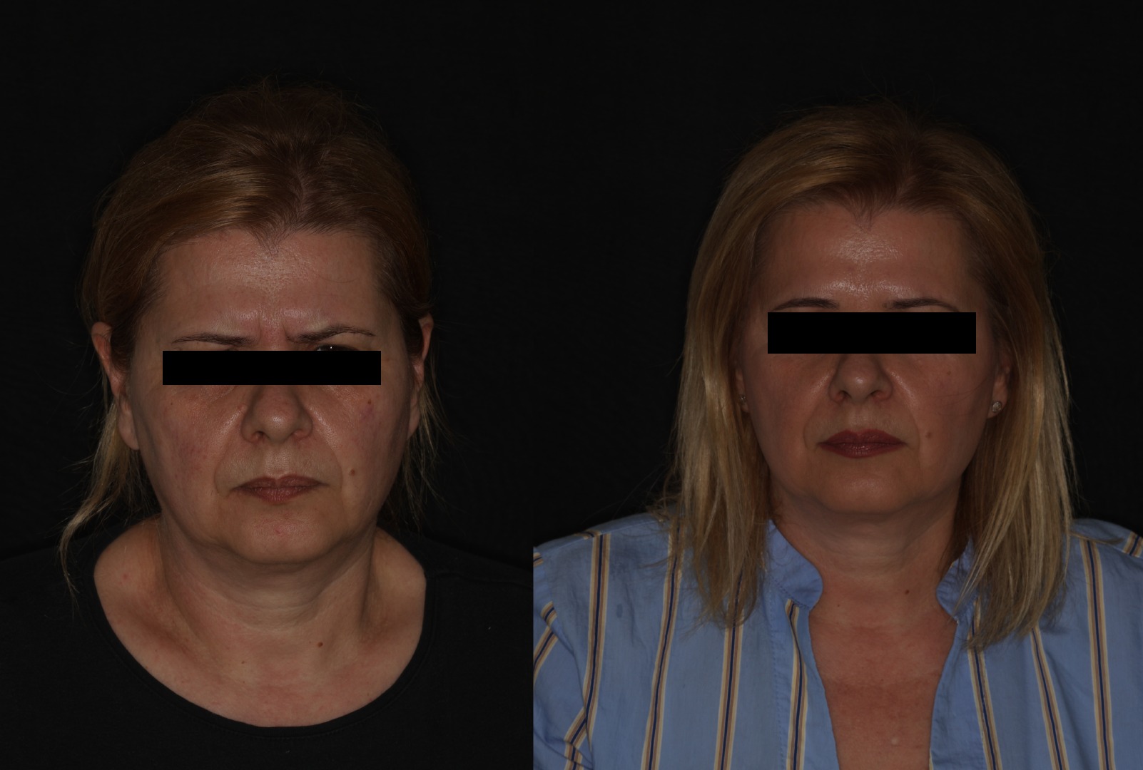 Botox