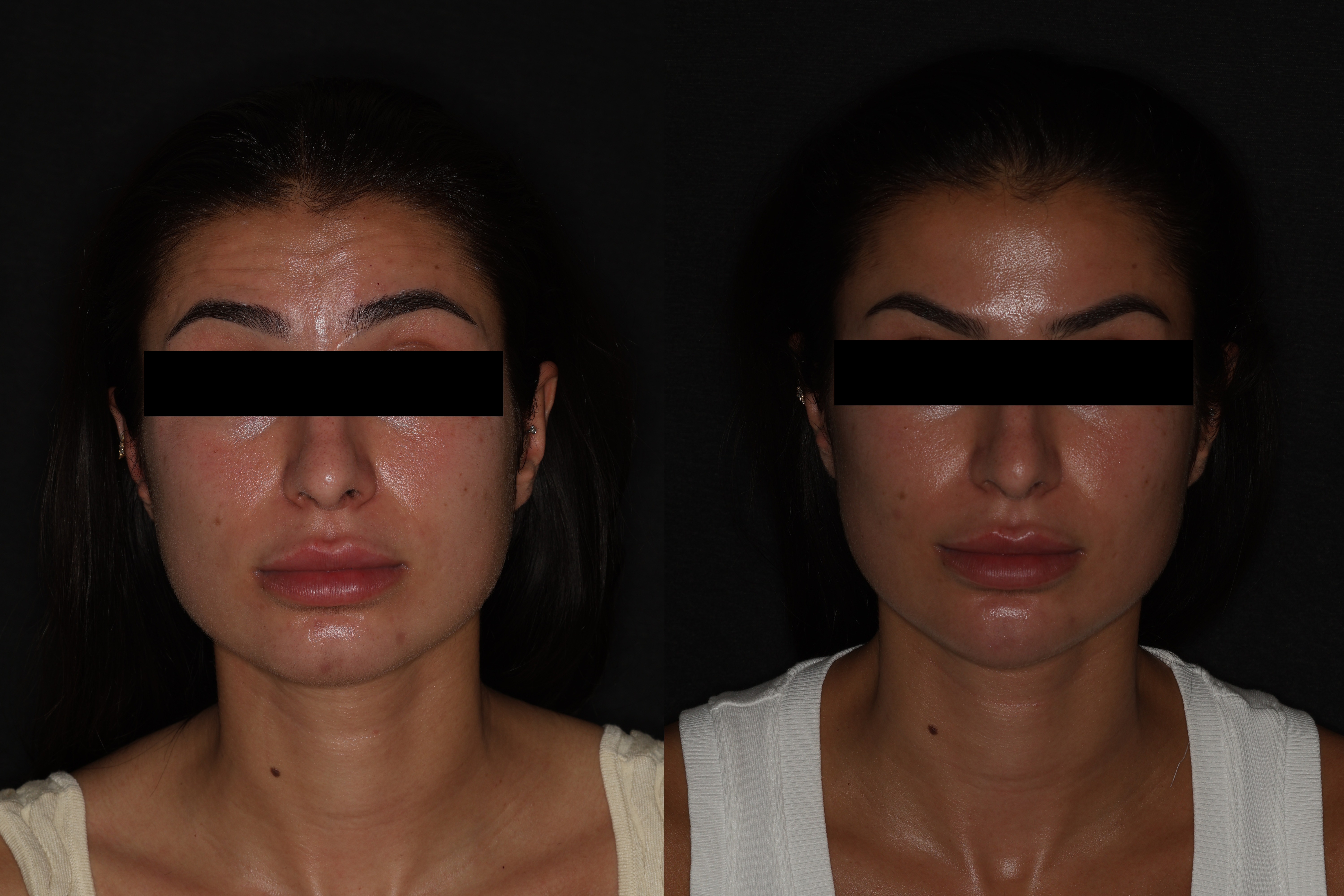Botox