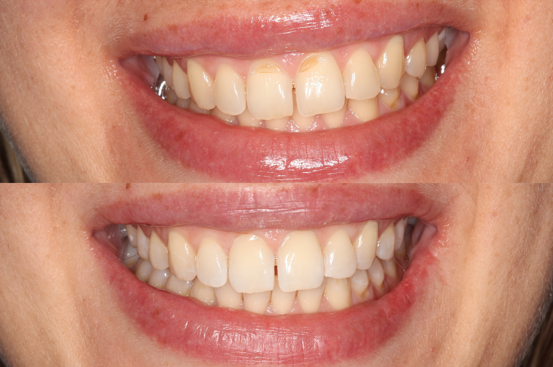 Anterior Composites