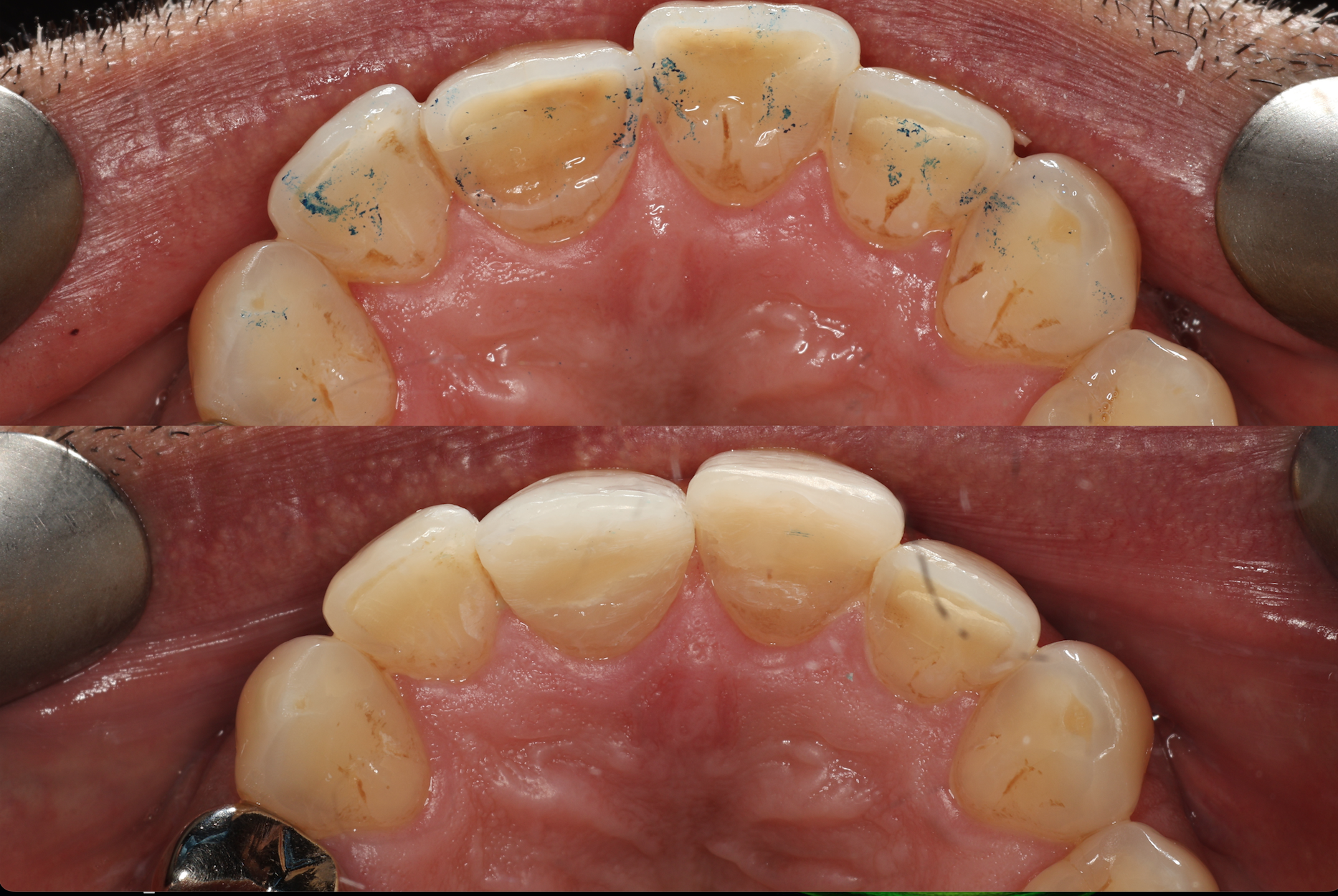 Toothwear