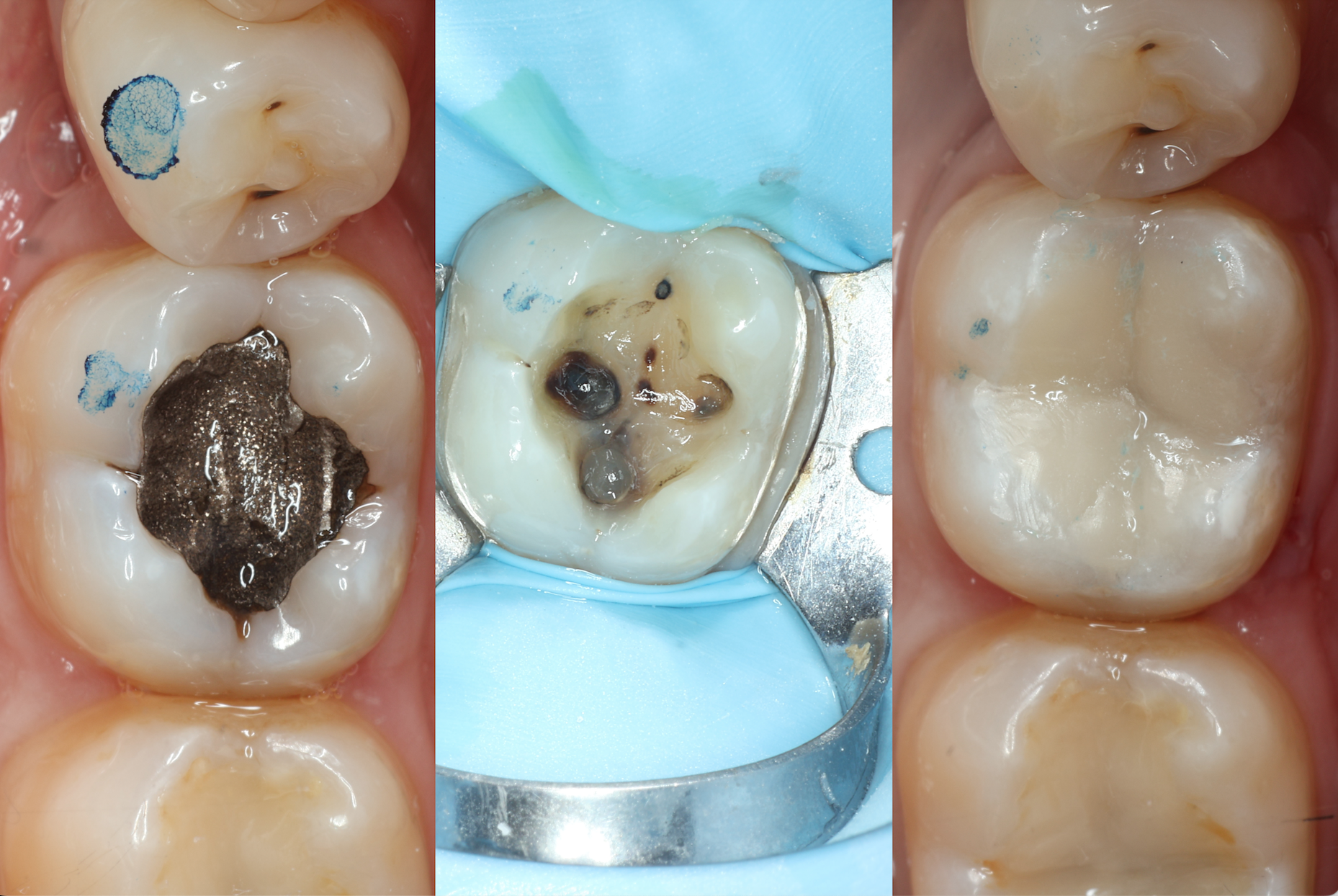 Posterior Composite