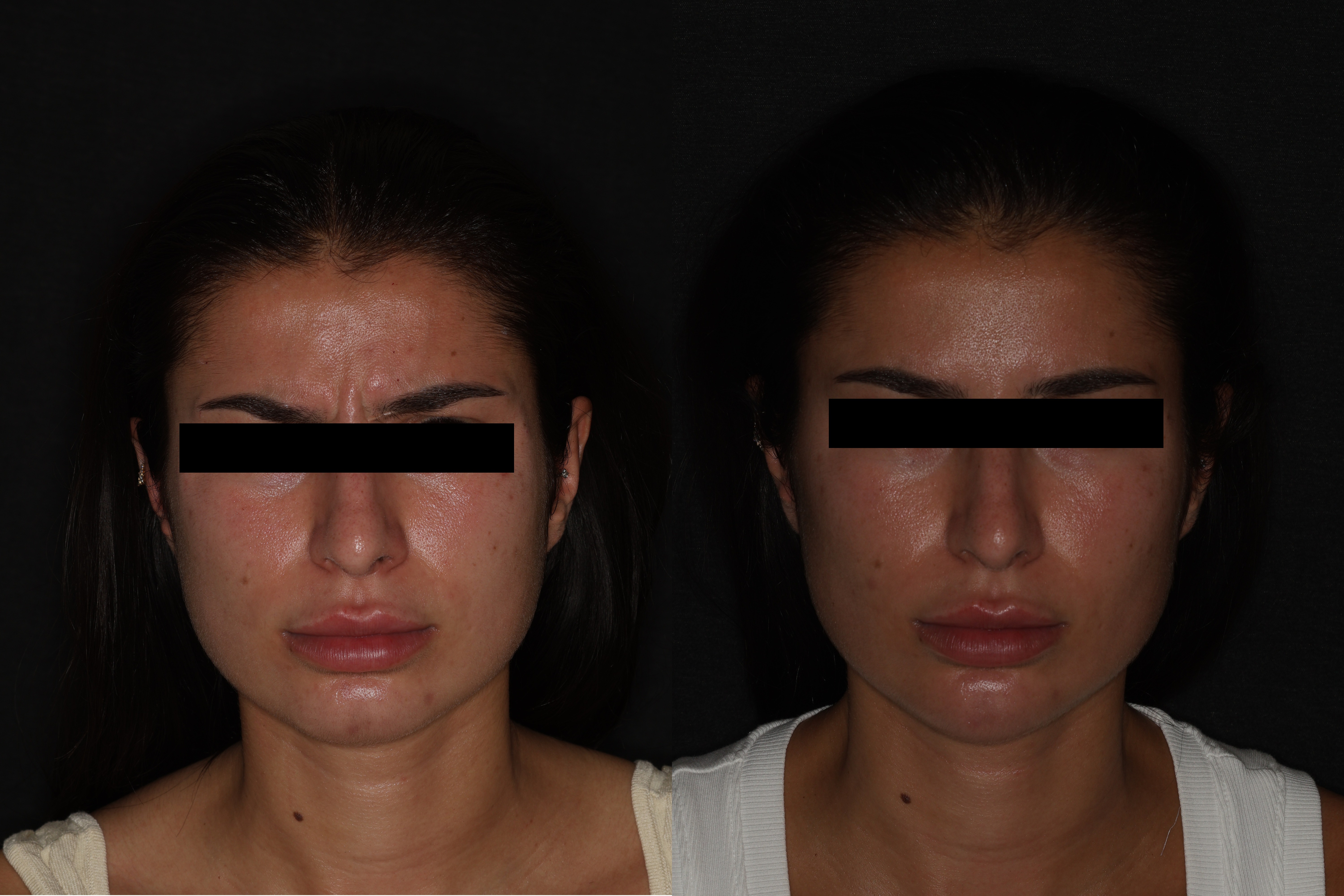 Botox