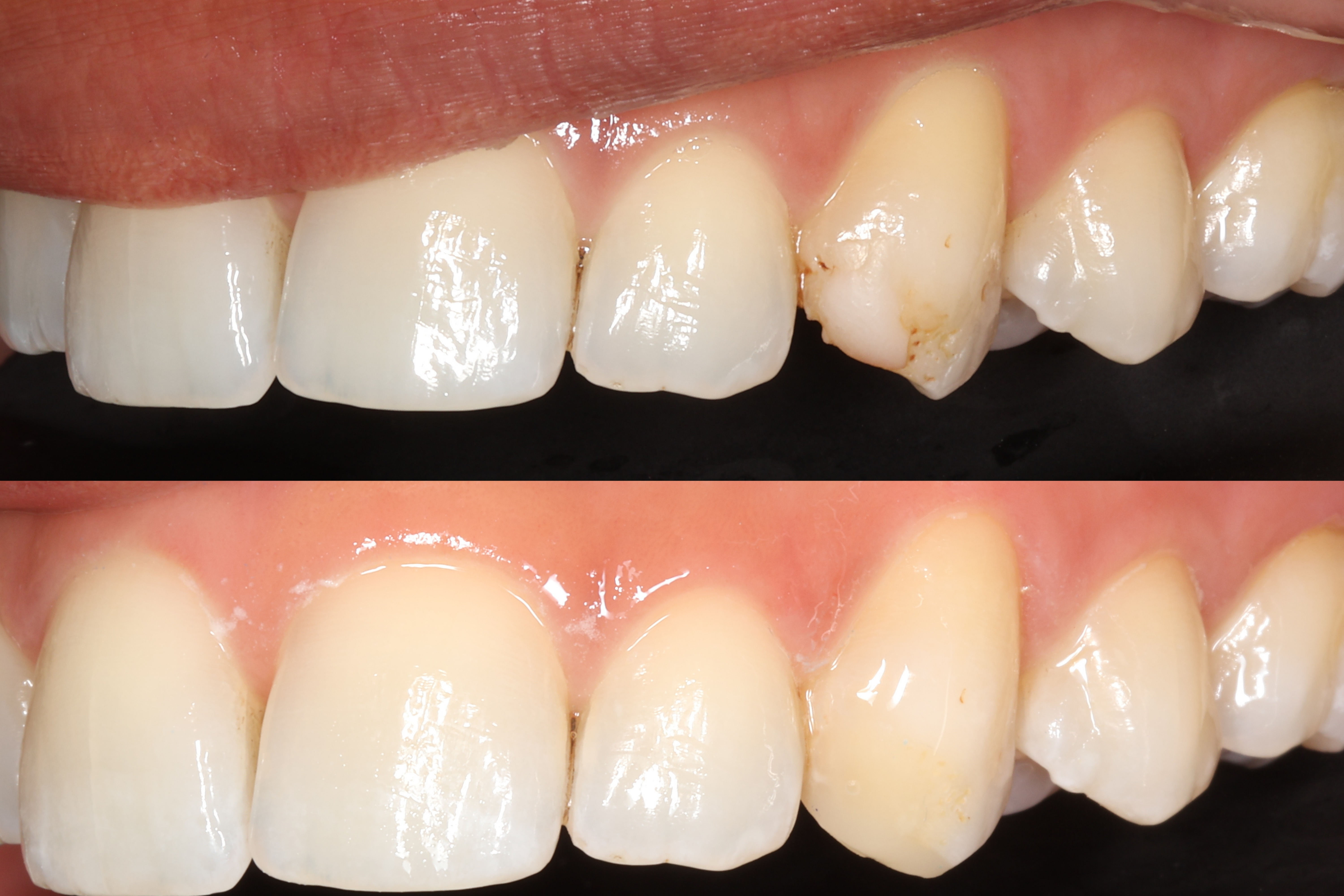 Anterior Composite
