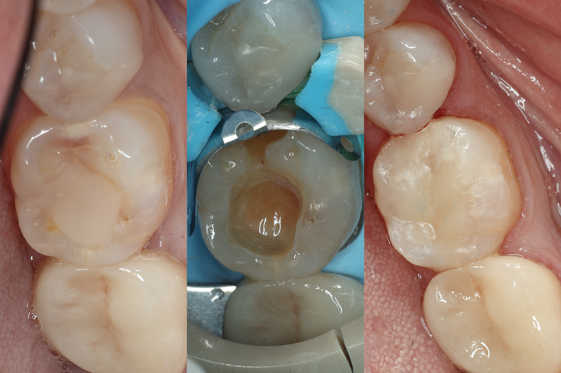 Posterior Composite