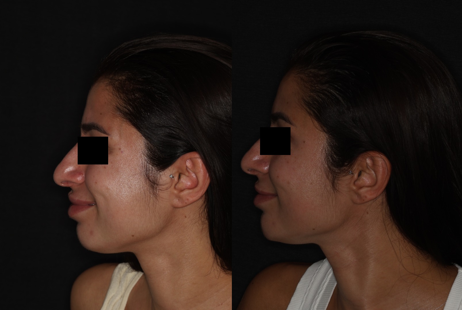 Botox