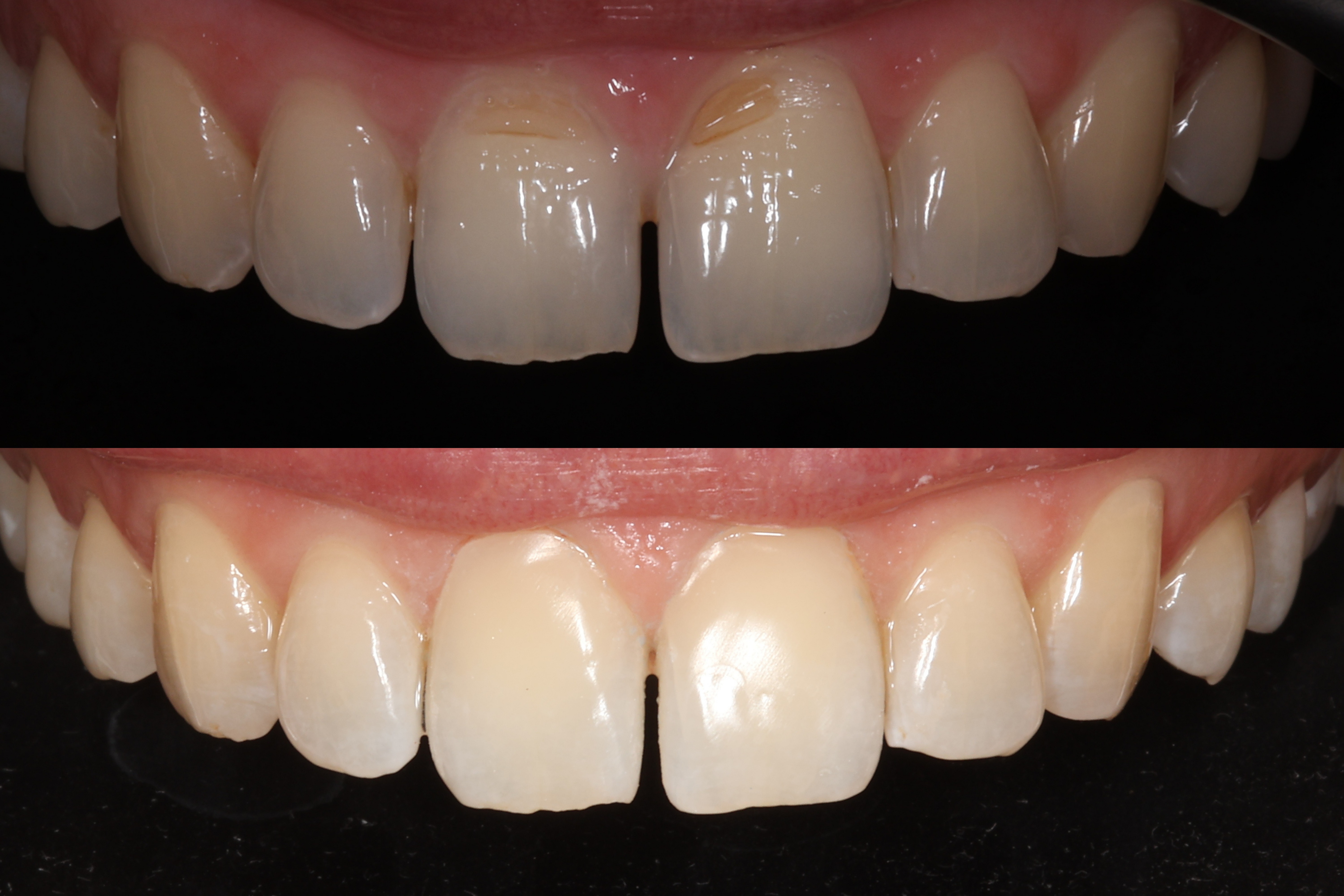 Anterior Composites