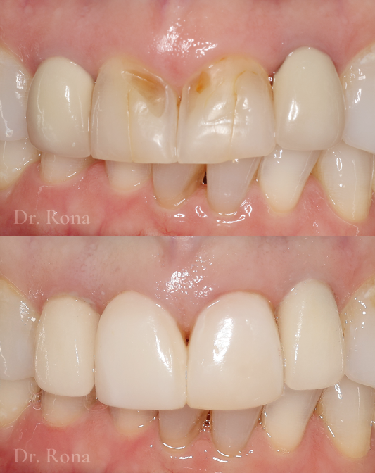 Anterior Crowns