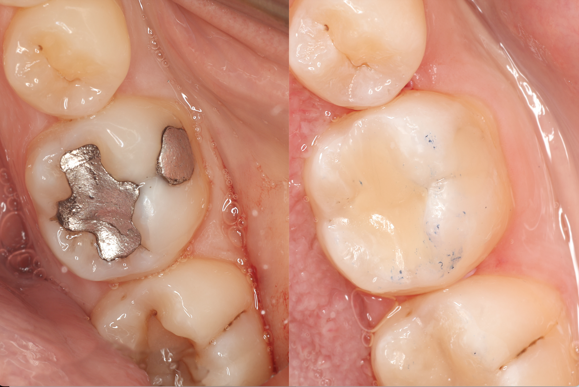 Posterior Restorations