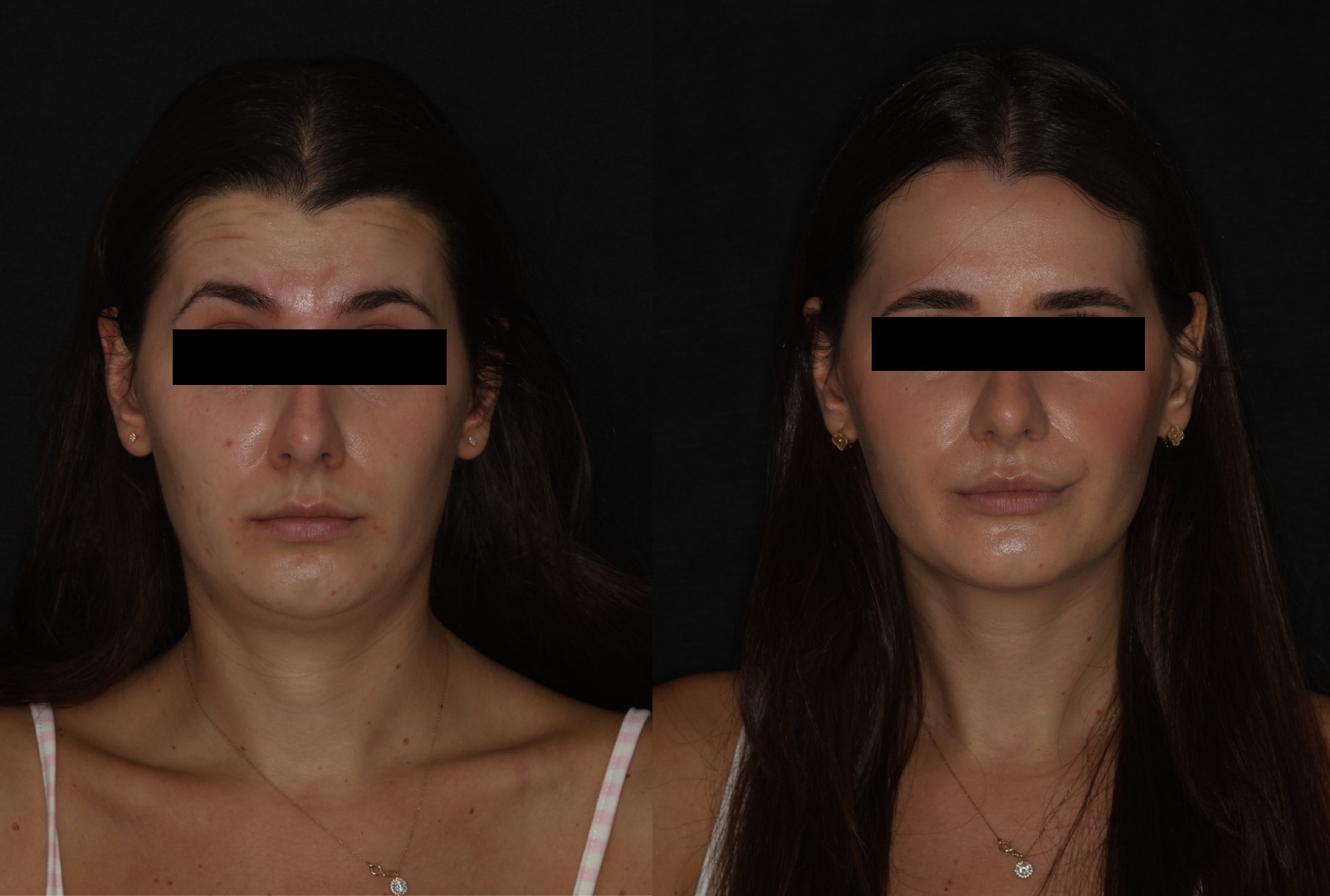 Botox