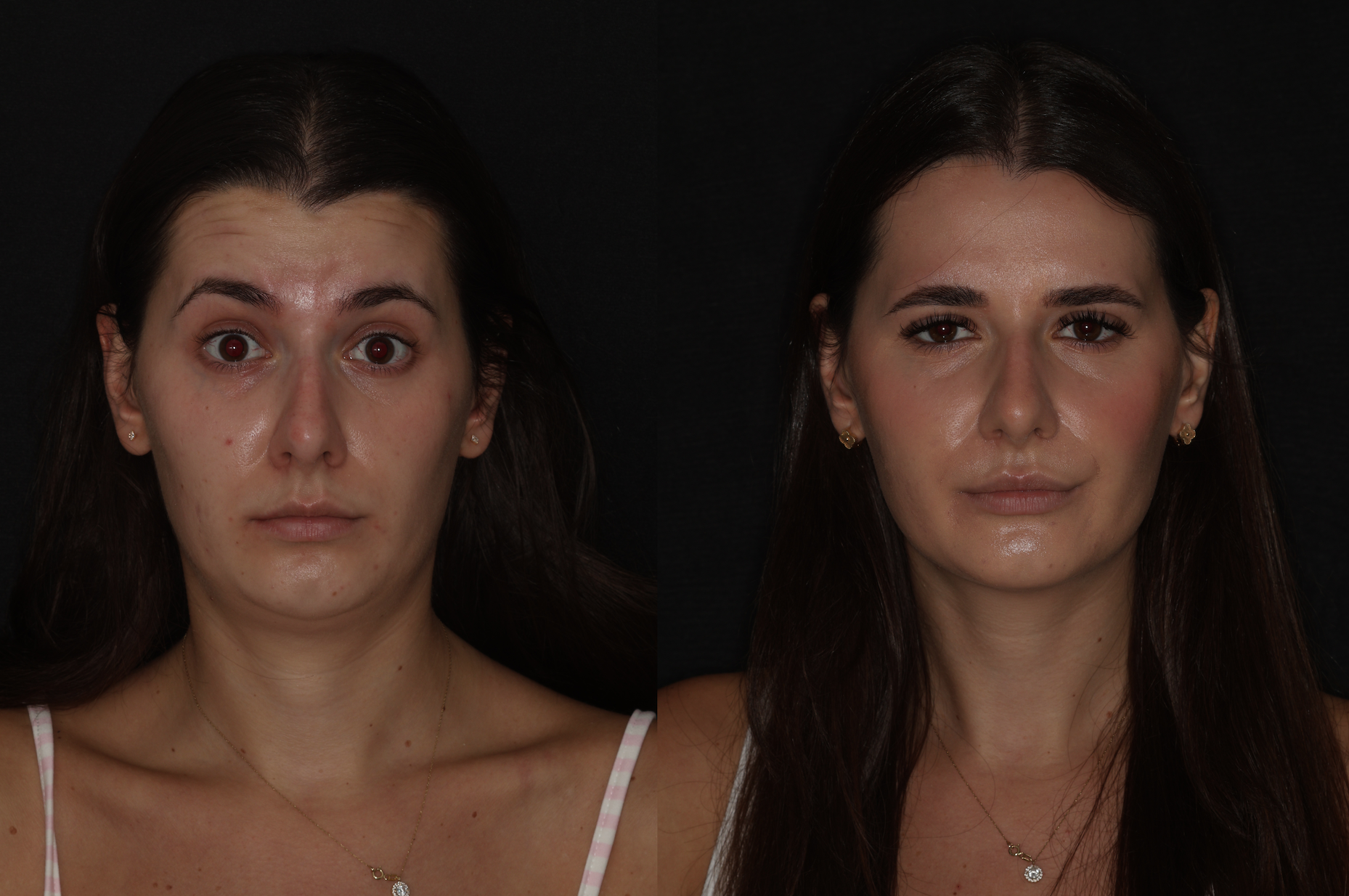 Botox