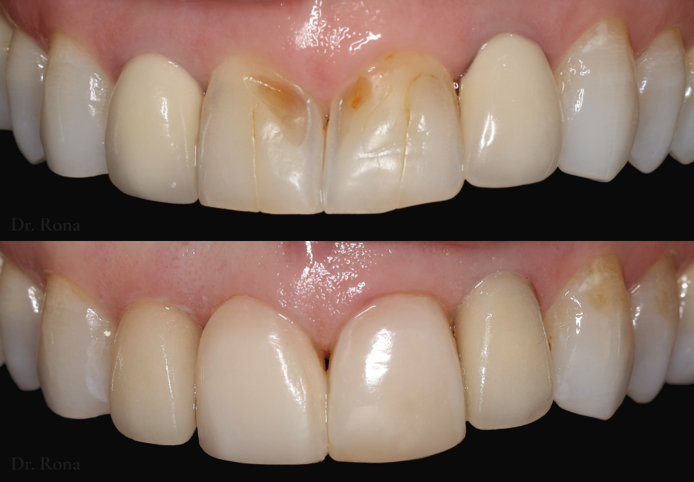 Anterior Crowns