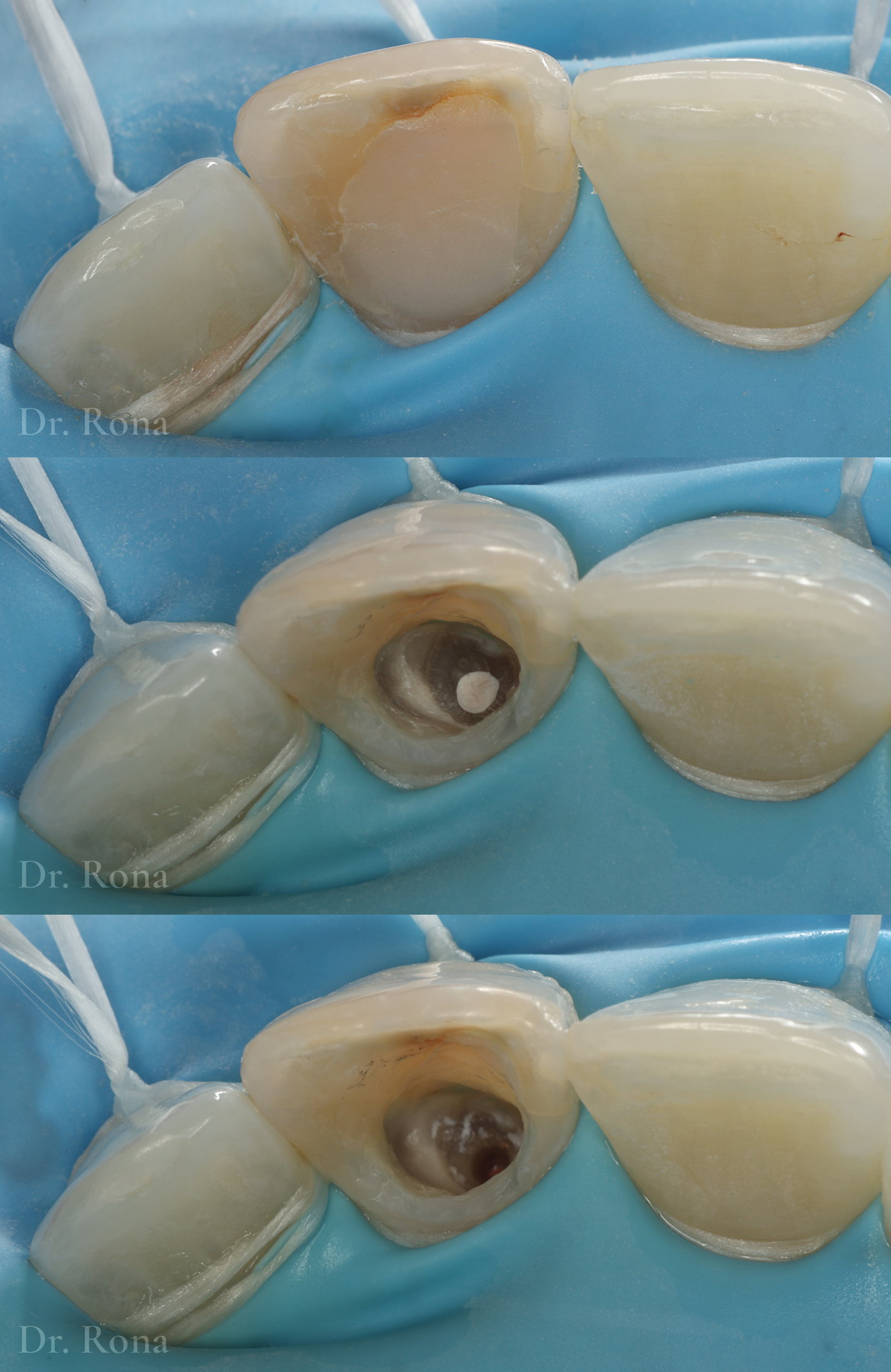 Internal bleaching