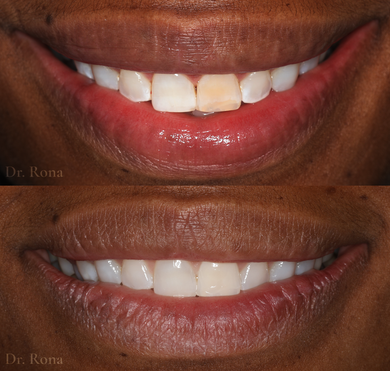 Internal bleaching
