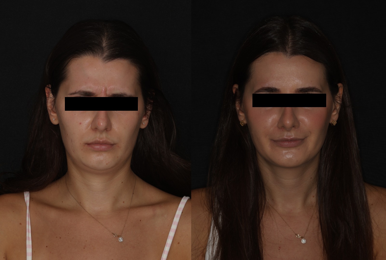 Botox