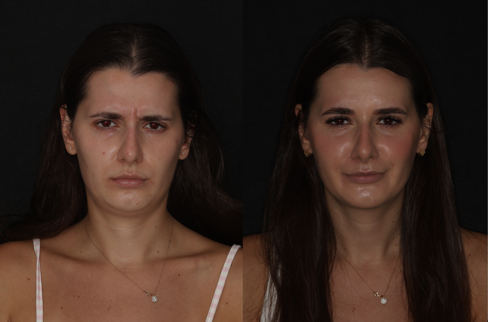 Botox
