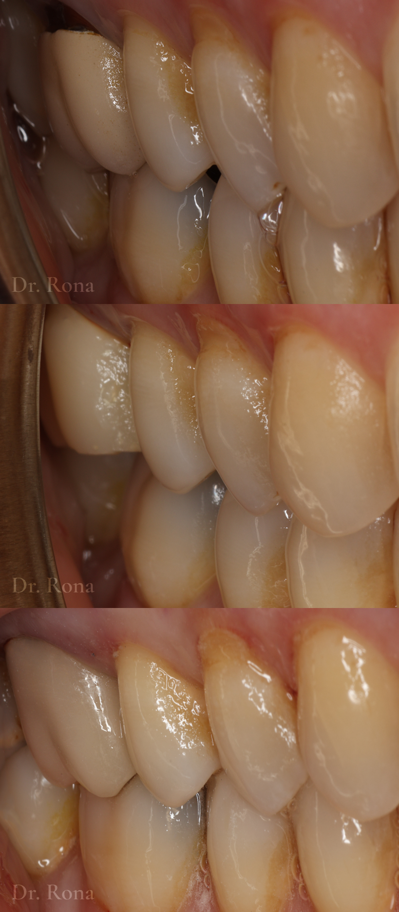 Posterior Crown