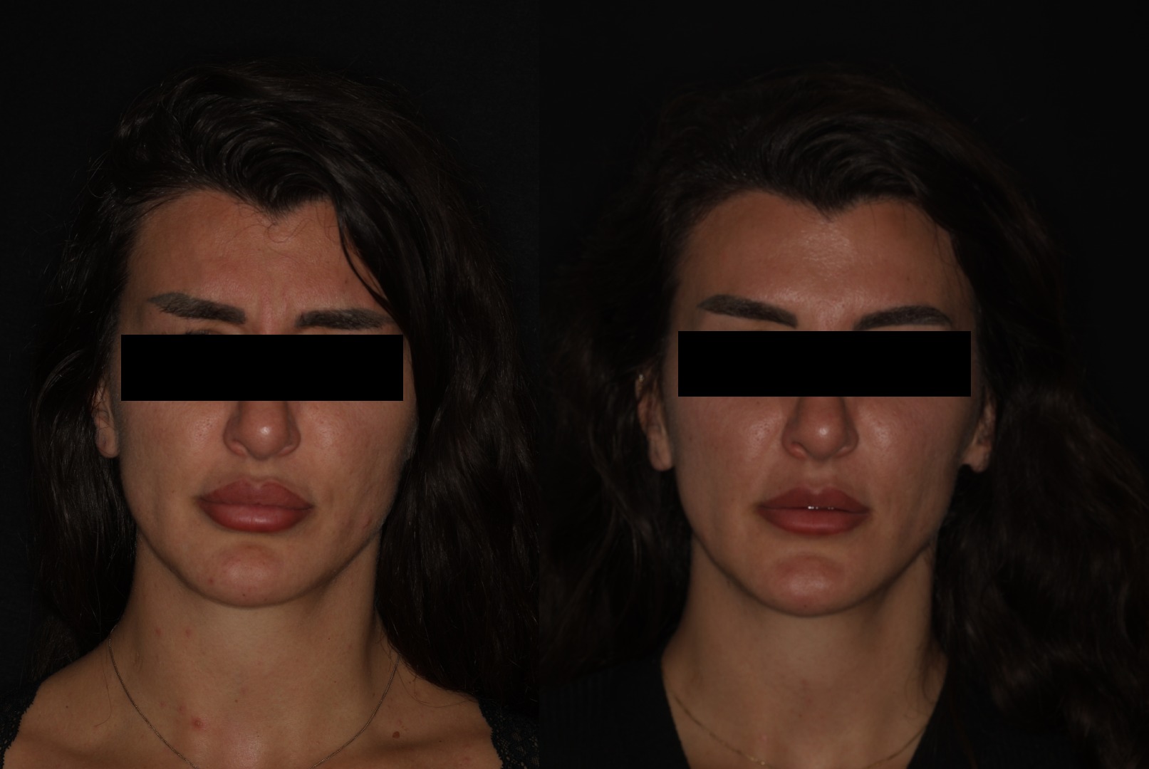 Botox