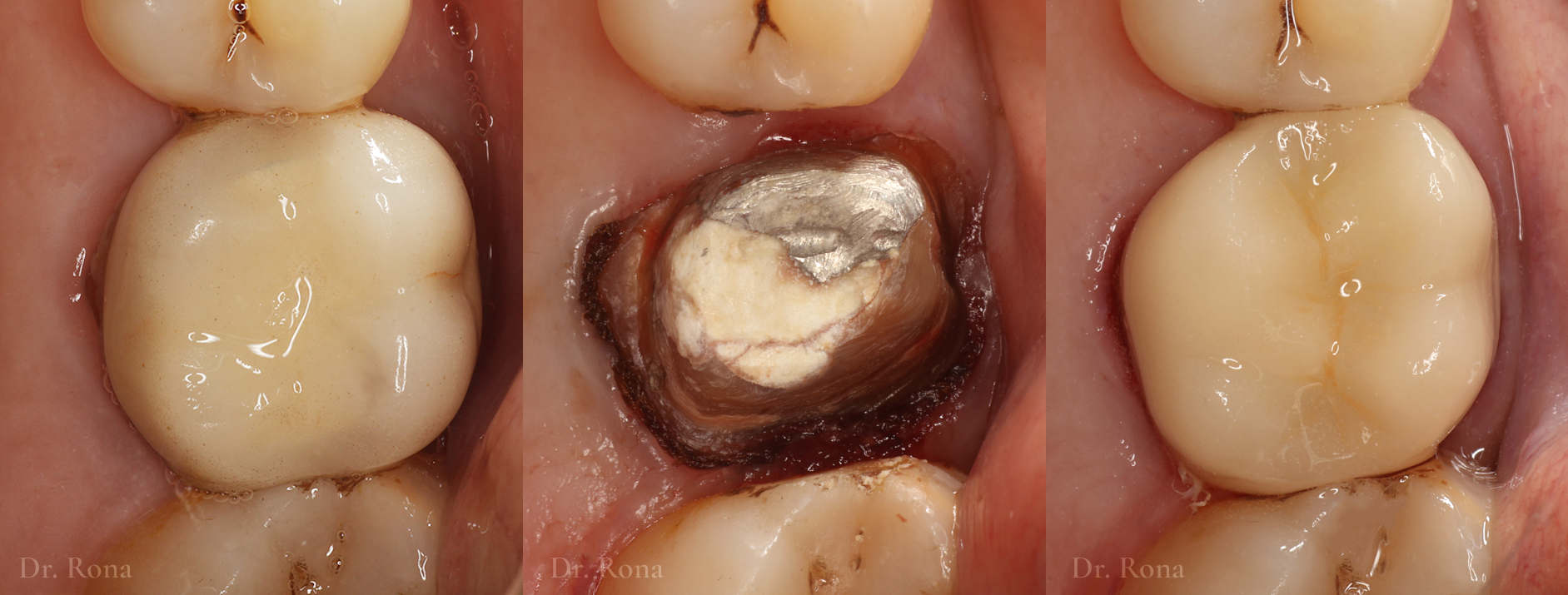 Posterior Crown