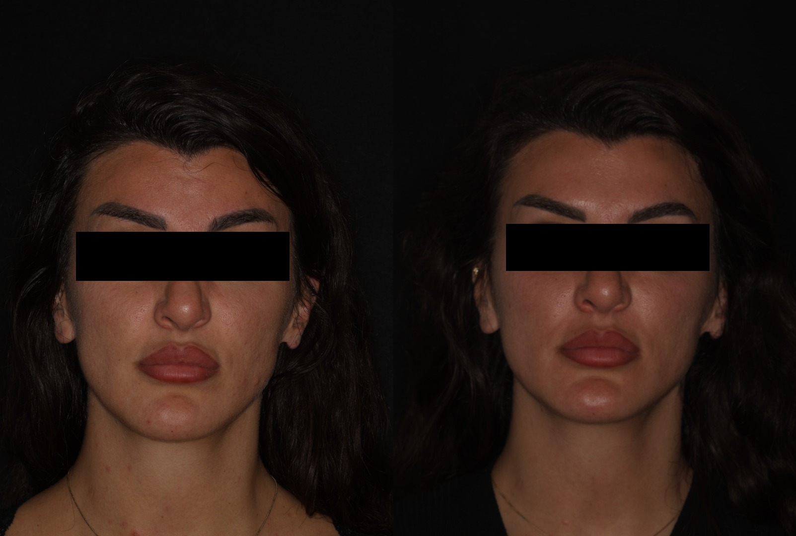 Botox