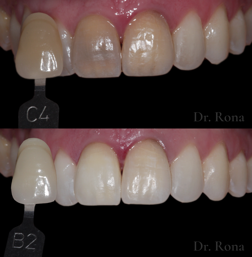 Internal bleaching