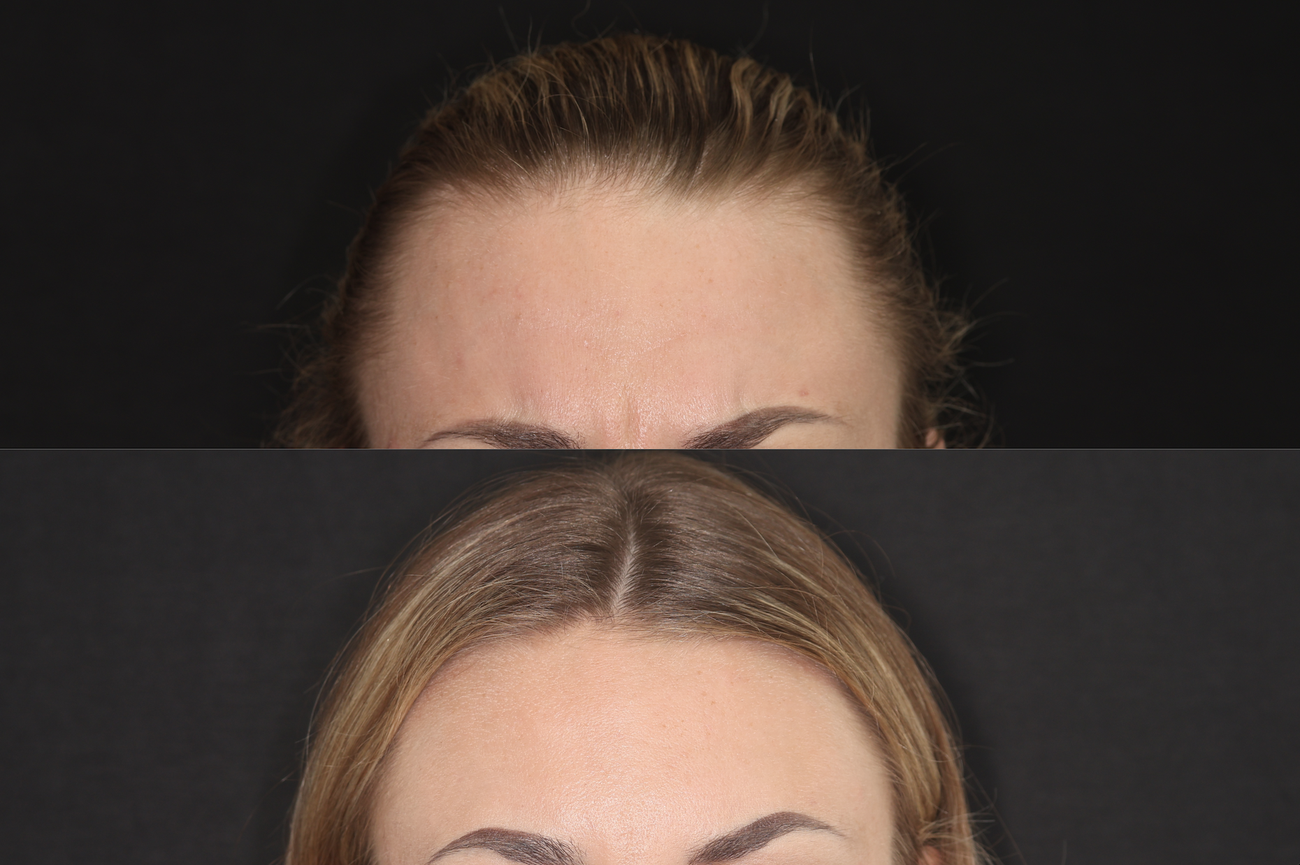 Botox