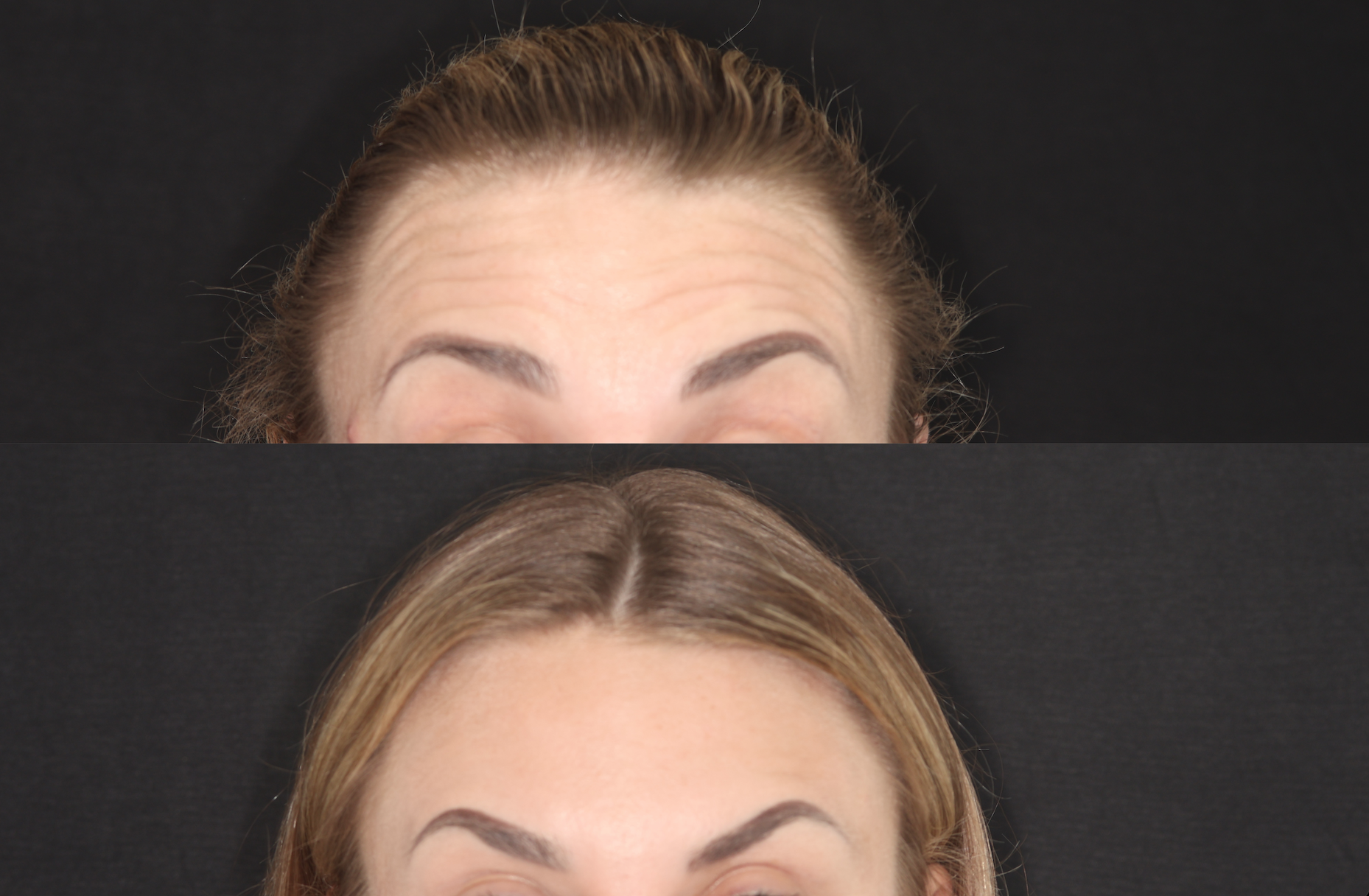 Botox
