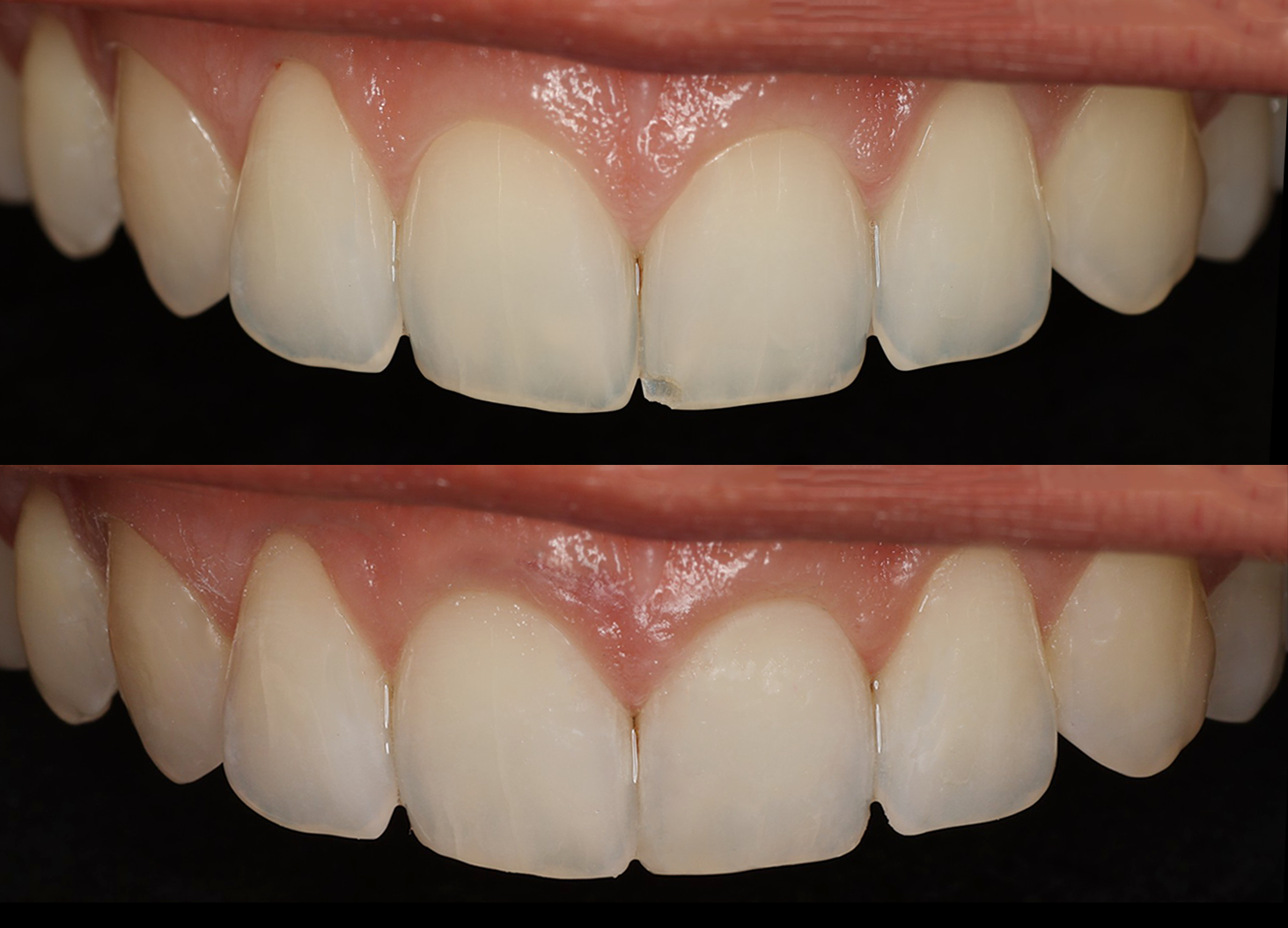 Anterior Composites