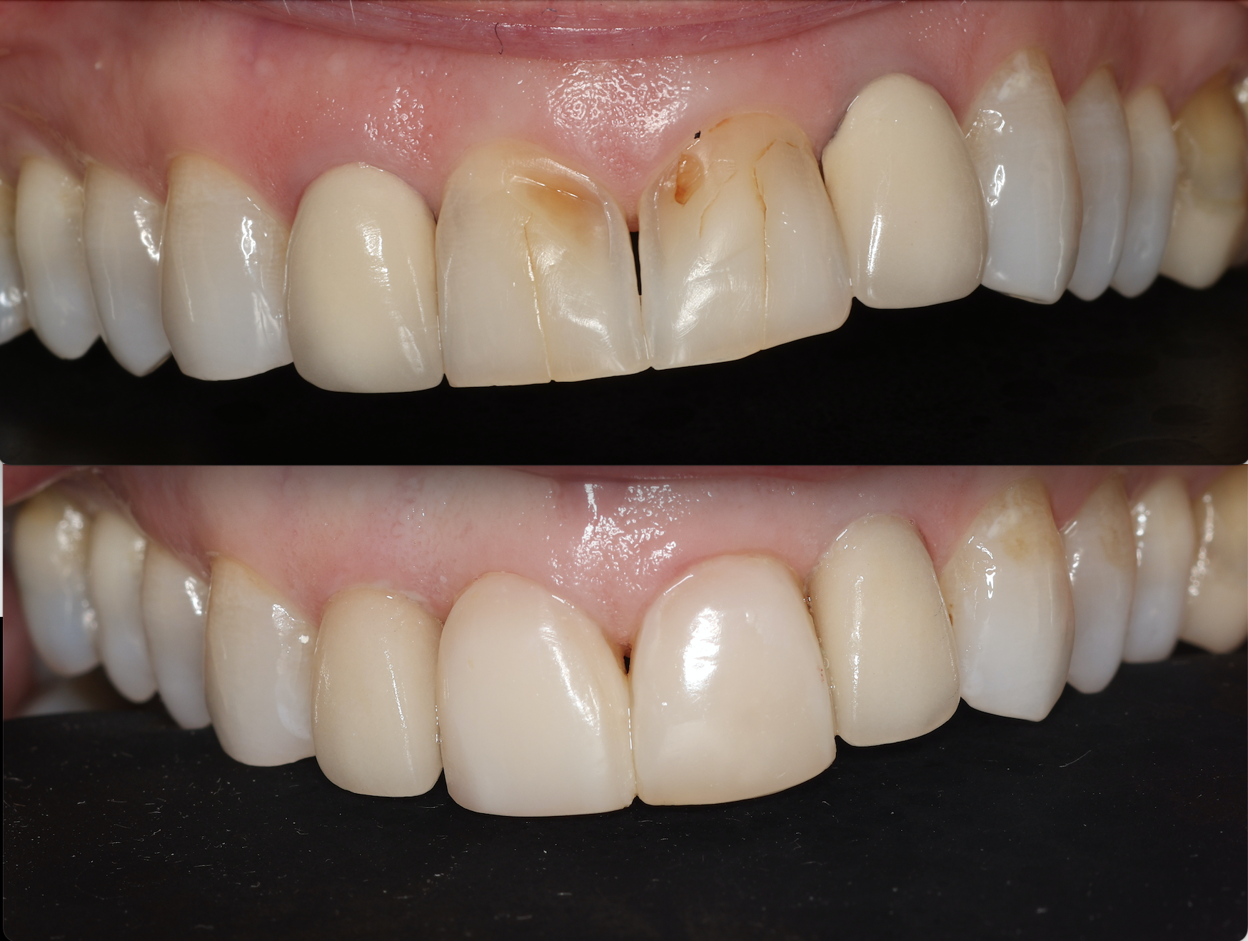 Anterior Composite